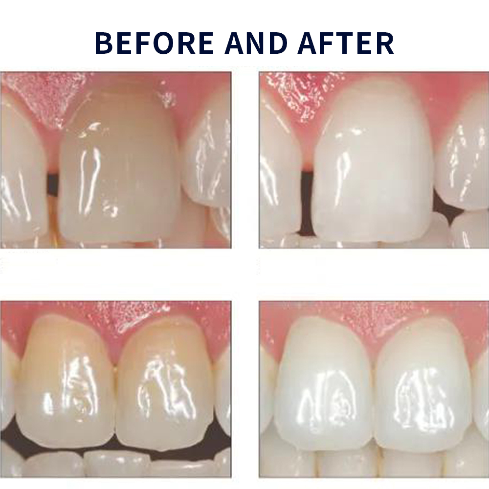 Opalescencia blanqueadora 20%  - Teeth Whitening Gel Peroxide reseña y precio