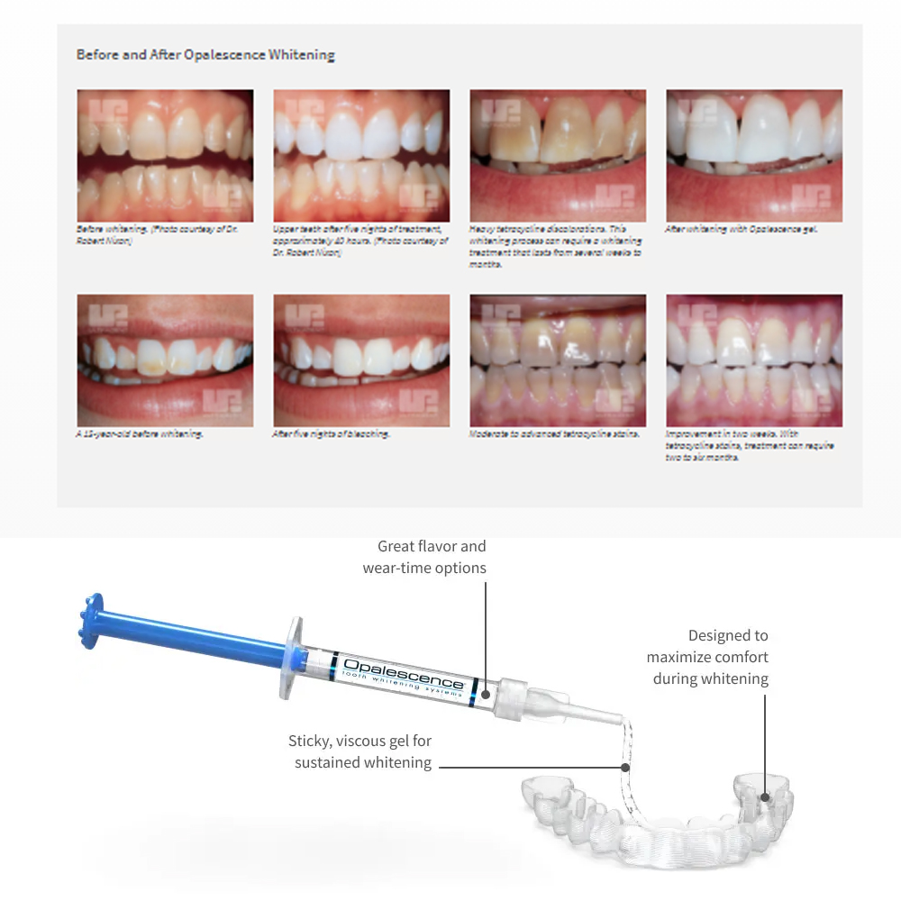 Opalescencia blanqueadora 20%  - Teeth Whitening Gel Peroxide reseña y precio