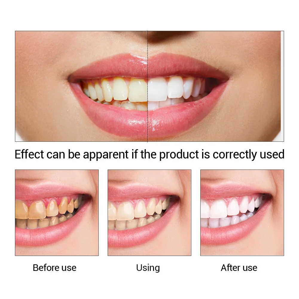 FTEENPLY-esencia para blanquea - Teeth Whitening Diy reseña y precio