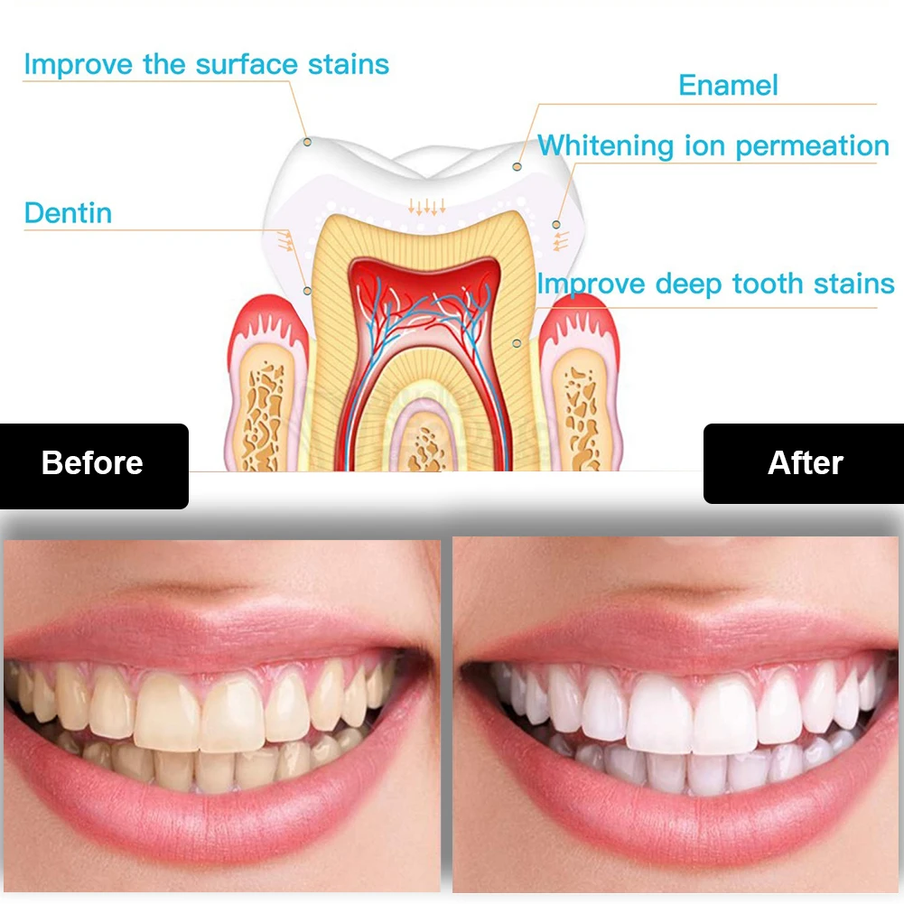 Kit de blanqueamiento Dental M - Teeth Whitening Gel Peroxide reseña y precio